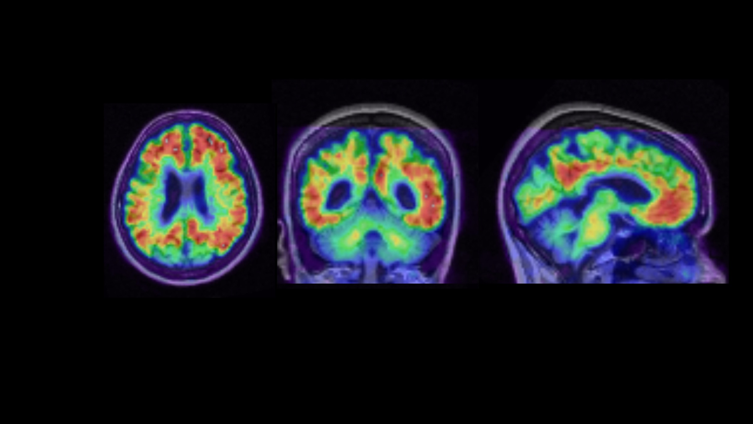 Color MRI scan of a brain from top-down, forward-facing, and side angles.